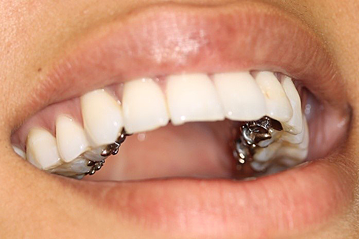 INBRACE Lingual Braces, District Orthodontics