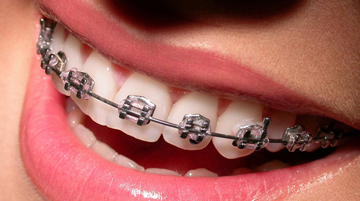 Metal Braces  Riviera Orthodontics